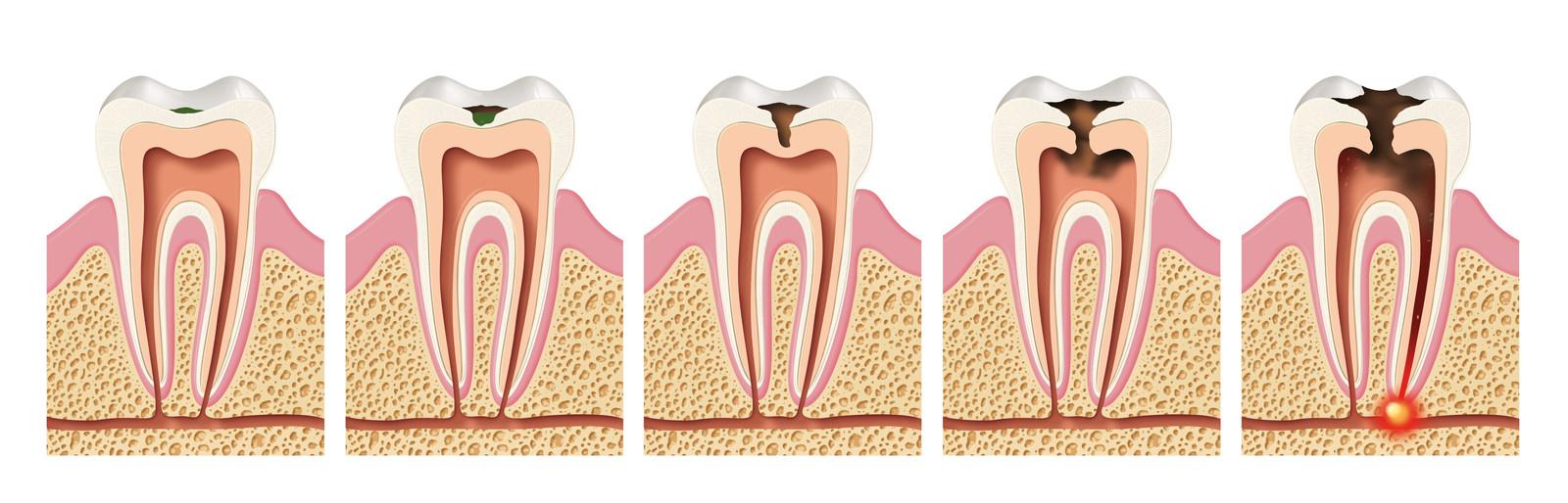 Fases de la caries en cinco cortes de un molar: desde la mancha inicial en el esmalte hasta la infección en la raíz