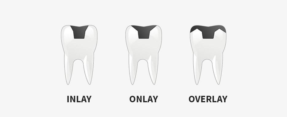 ¿Qué es una incrustación dental y cuándo se realiza?