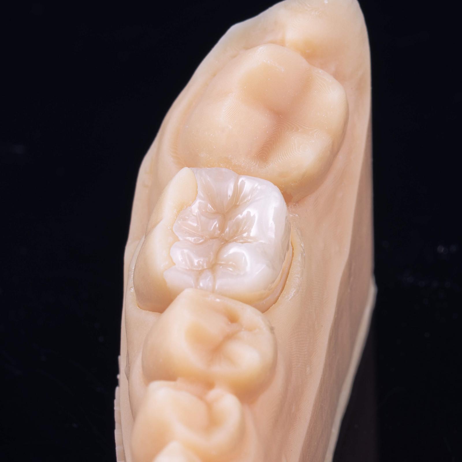 foto de un diente con una incrustación dental