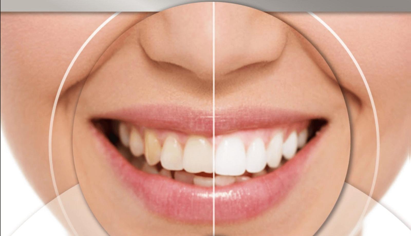 ¿Cómo puedo eliminar las manchas en los dientes?