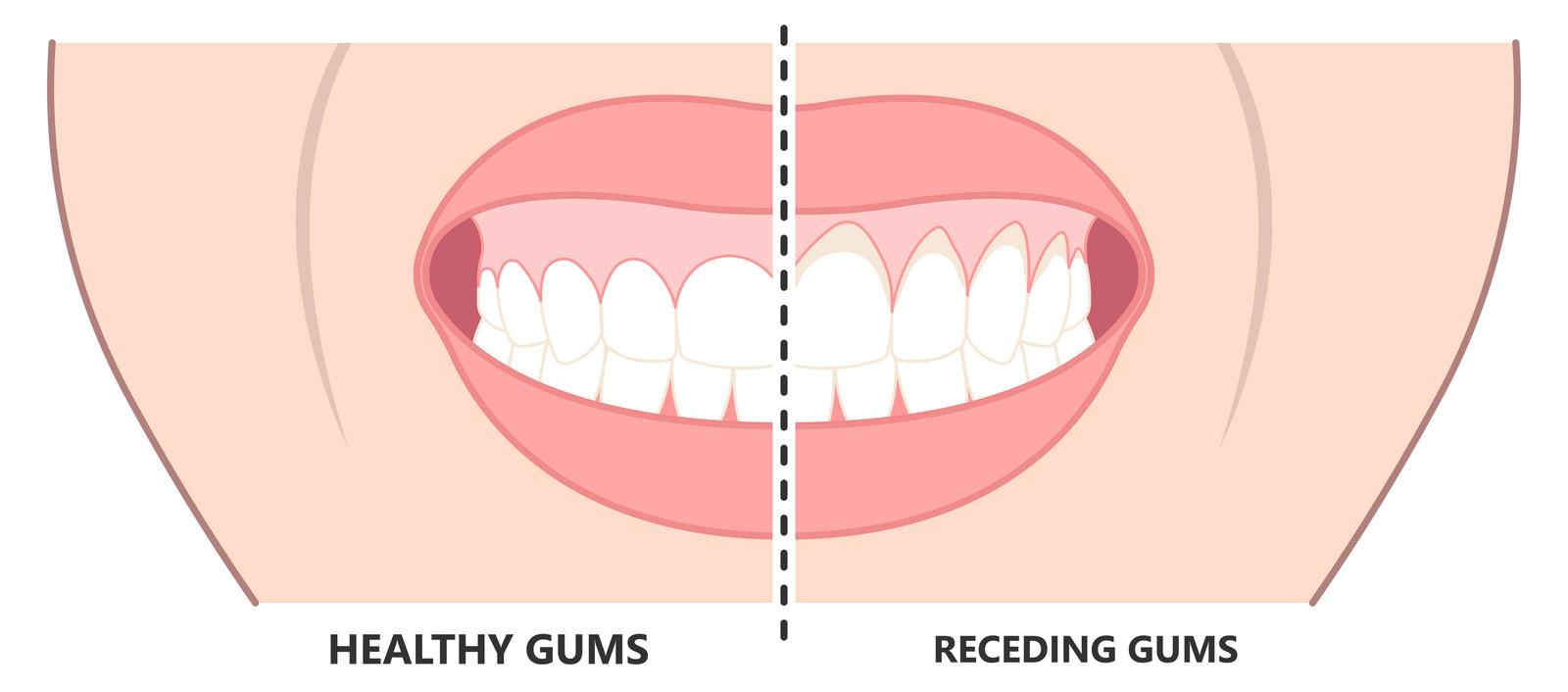 Comparación de unas encías sanas (izquierda) y unas encías retraídas (derecha), con la raíz de los dientes al descubierto