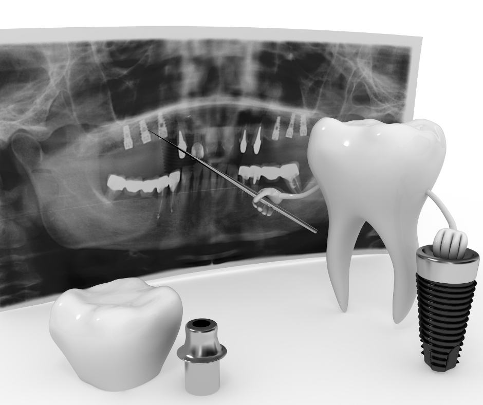 Todo lo que necesitas saber sobre Implantes Dentales (parte I)