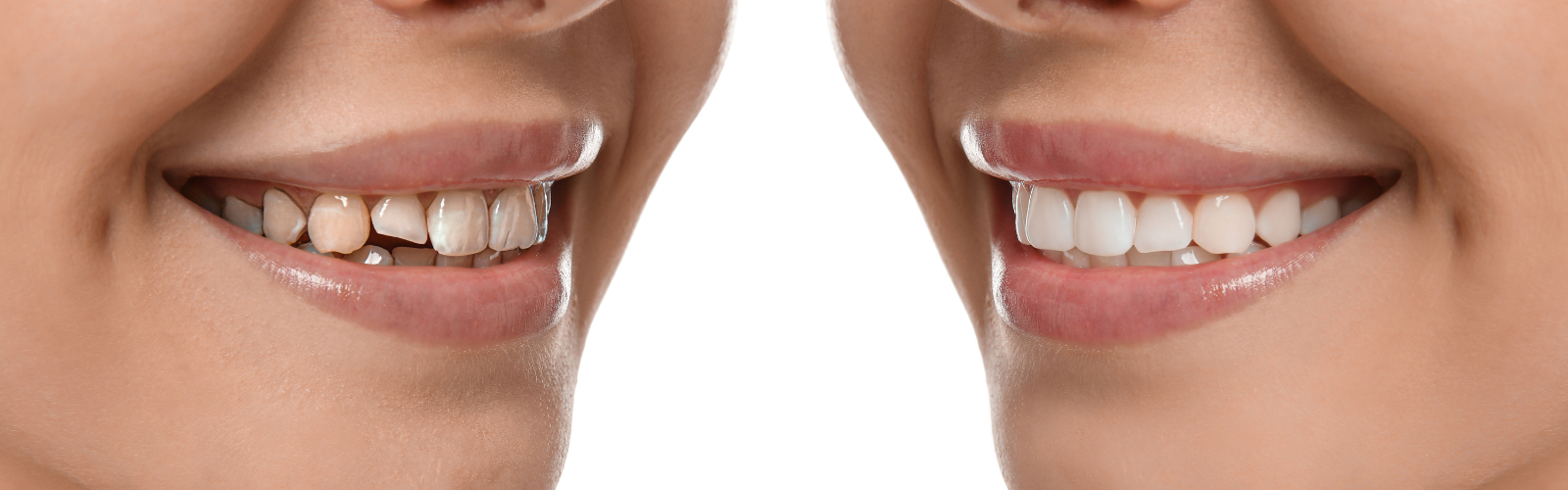 ¿Qué es un diseño digital de sonrisa?