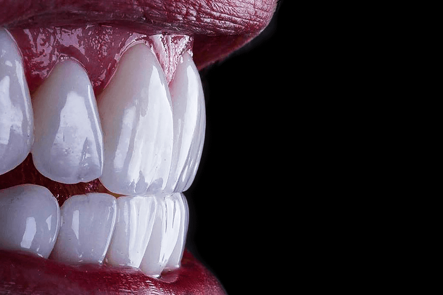 ¿Qué son las carillas dentales?