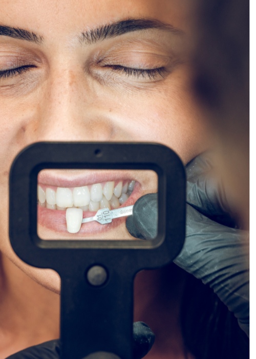 cara de una mujer con los ojos cerrados, vemos la mano de un odontólogo con guantes negros, que está viendo el color de los dientes de la chica usando una guía