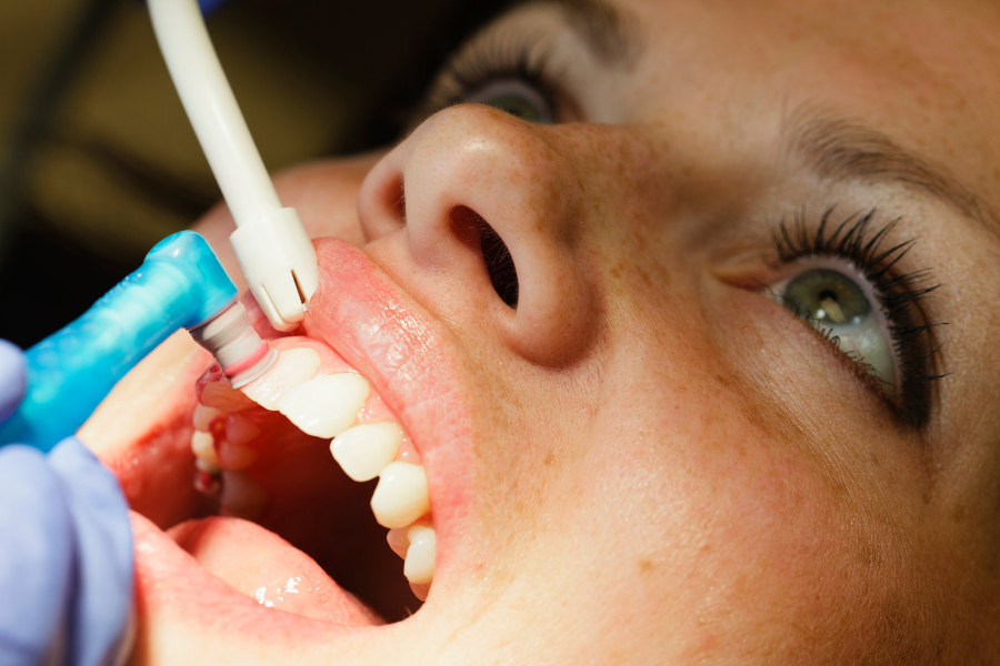 ¿Por qué es importante hacerse una limpieza dental?